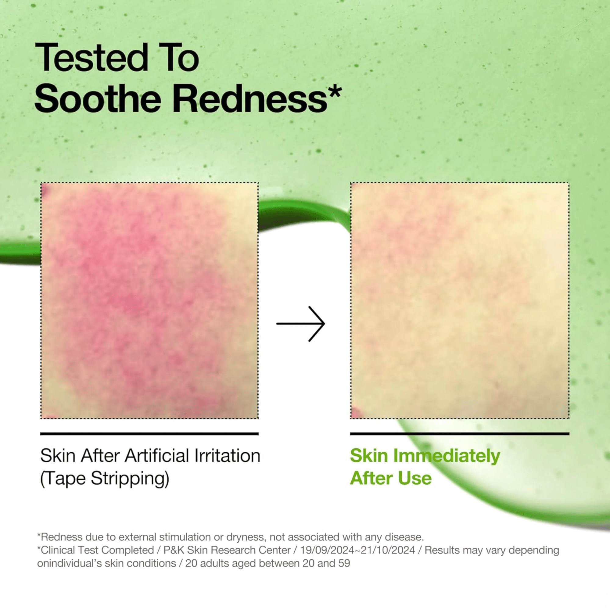 Anua Azelaic Acid 10+ Hyaluron Redness Soothing Serum 30ml - cosmadic